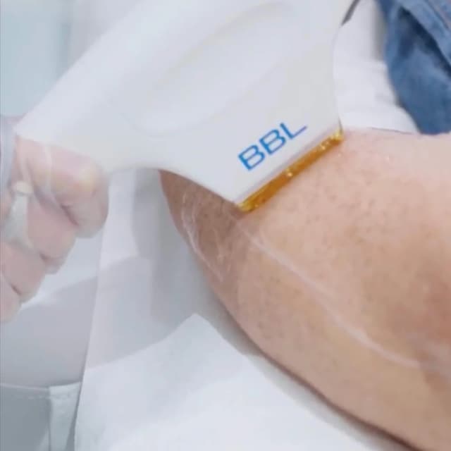 BBL Full Arms-3 Pack at The Skin Concierge in Northbrook, IL