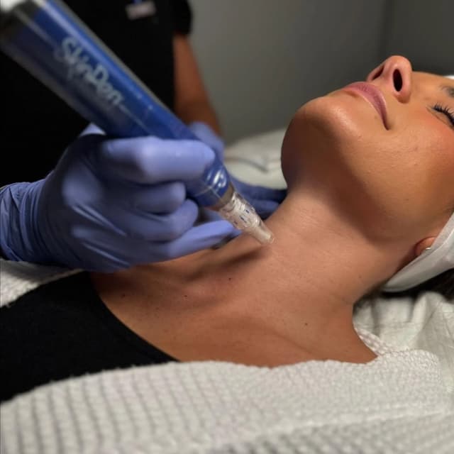 SkinPen Microneedling Face/Chest at The Skin Concierge in Northbrook, IL