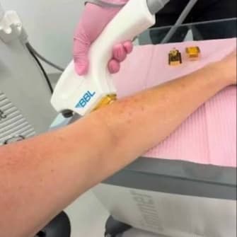 BBL Forearm at The Skin Concierge in Northbrook, IL